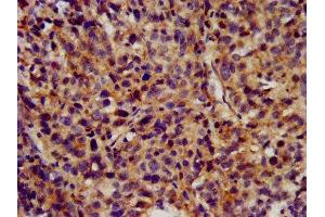 IHC image of ABIN7163969 diluted at 1:300 and staining in paraffin-embedded human ovarian cancer performed on a Leica BondTM system. (KCNC3 Antikörper  (AA 638-745))