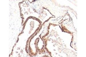 Formalin-fixed, paraffin-embedded human prostate cancer stained with p27Kip1 antibody (KIP1/769) (CDKN1B Antikörper)