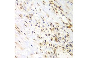 Immunohistochemistry of paraffin-embedded human gastric cancer using LHX4 antibody at dilution of 1:100 (x400 lens). (LHX4 Antikörper)
