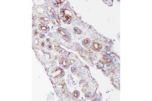 Anti-PCSK9 antibody, IHC(P): Human Intestinal Cancer Tissue