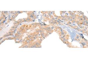 Immunohistochemistry of paraffin-embedded Human thyroid cancer tissue using RGS19 Polyclonal Antibody at dilution of 1:40(x200)