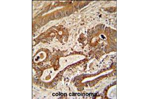 ETHE1 Antibody immunohistochemistry analysis in formalin fixed and paraffin embedded human colon carcinoma followed by peroxidase conjugation of the secondary antibody and DAB staining.