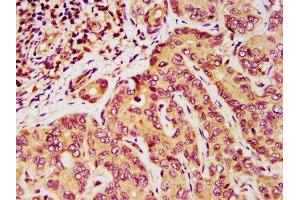 IHC image of ABIN7149816 diluted at 1:200 and staining in paraffin-embedded human liver cancer performed on a Leica BondTM system.