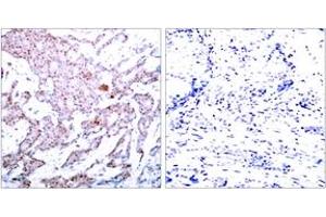Immunohistochemistry analysis of paraffin-embedded human breast carcinoma, using NF-kappaB p65 (Phospho-Ser536) Antibody.