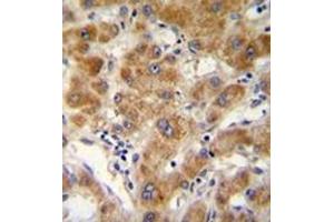 Immunohistochemistry analysis in formalin fixed and paraffin embedded human hepatocarcinoma reacted with ODF3B Antibody (N-term) followed by peroxidase conjugation of the secondary antibody and DAB staining. (ODF3B Antikörper  (N-Term))
