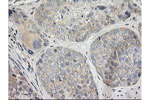 Immunohistochemical staining of paraffin-embedded Adenocarcinoma of Human breast tissue using anti-ITFG2 mouse monoclonal antibody. (ITFG2 Antikörper)