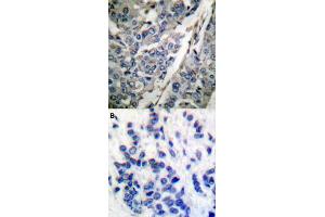 Immunohistochemical staining (Formalin-fixed paraffin-embedded sections) of human breast cancer tissue with SYT1 (phospho T202) polyclonal antibody  without blocking peptide (A) or preincubated with blocking peptide (B) under 1:50-1:100 dilution. (SYT1 Antikörper  (pThr202))