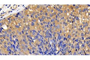 Detection of BCL2L11 in Human Breast cancer Tissue using Polyclonal Antibody to Bcl2 Like Protein 11 (BCL2L11) (BIM Antikörper  (AA 2-120))