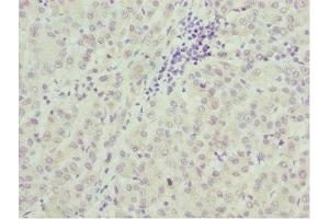 Immunohistochemistry of paraffin-embedded human liver cancer using ABIN7172689 at dilution of 1:100