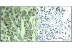 Immunohistochemical analysis of paraffin-embedded human breast carcinoma tissue using c-Cbl(Phospho-Tyr700) Antibody(left) or the same antibody preincubated with blocking peptide(right). (CBL Antikörper  (pTyr770))