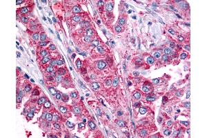 Anti-BAI2 antibody IHC of human Lung, Non-Small Cell Carcinoma. (BAI2 Antikörper  (C-Term))