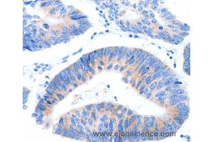 Immunohistochemistry of Human lung cancer using MUC3A Polyclonal Antibody at dilution of 1:60 (MUC3A Antikörper)