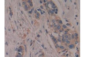 Detection of CYP27B1 in Human Breast cancer Tissue using Polyclonal Antibody to Cytochrome P450 27B1 (CYP27B1) (CYP27B1 Antikörper  (AA 256-508))