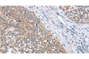 Immunohistochemistry of paraffin-embedded Human cervical cancer tissue using PAPSS1 Polyclonal Antibody at dilution 1:40 (PAPSS1 Antikörper)