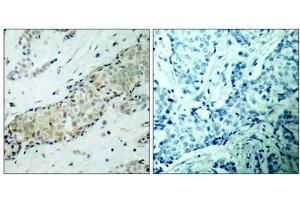 Immunohistochemical analysis of paraffin- embedded human breast carcinoma tissue, using HDAC5 (Ab-498) Antibody (E021142). (HDAC5 Antikörper)