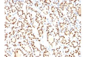 Formalin-fixed, paraffin-embedded human Thyroid stained with TTF-1 Mouse Monoclonal Antibody (8G7G3/1). (NKX2-1 Antikörper)