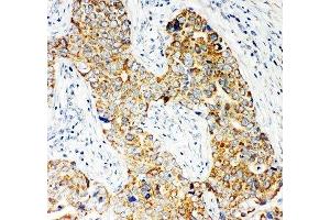 IHC-P: NOX5 antibody testing of human breast cancer tissue (NOX5 Antikörper  (C-Term))