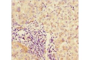 Immunohistochemistry of paraffin-embedded human liver cancer using ABIN7176590 at dilution of 1:100 (DPF1 Antikörper  (AA 261-380))