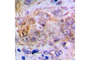 Immunohistochemical analysis of Carbonic Anhydrase 2 staining in human lung cancer formalin fixed paraffin embedded tissue section. (CA2 Antikörper  (C-Term))
