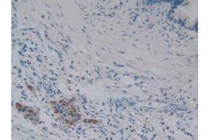 Detection of iPLA2 in Human Pancreas Tissue using Polyclonal Antibody to Phospholipase A2, Calcium Independent (iPLA2) (PNPLA2 Antikörper  (AA 484-701))