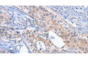 Immunohistochemistry of paraffin-embedded Human cervical cancer using INHBC Polyclonal Antibody at dilution of 1:50