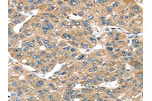 The image on the left is immunohistochemistry of paraffin-embedded Human liver cancer tissue using ABIN7192958(TUSC1 Antibody) at dilution 1/45, on the right is treated with synthetic peptide. (TUSC1 Antikörper)
