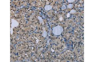 Immunohistochemistry of Human thyroid cancer using GYS1 Polyclonal Antibody at dilution of 1:50 (Glycogen Synthase 1 Antikörper)