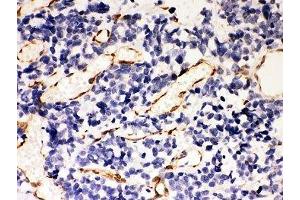 IHC-P: HSP47 antibody testing of human lung cancer tissue (SERPINH1 Antikörper  (AA 247-418))