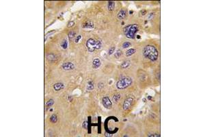 Formalin-fixed and paraffin-embedded human hepatocarcinoma tissue reacted with *ALDH6A1 antibody , which was peroxidase-conjugated to the secondary antibody, followed by DAB staining. (ALDH6A1 Antikörper  (C-Term))