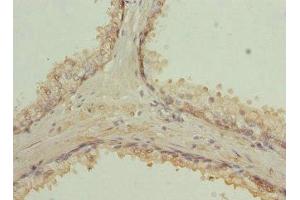 Immunohistochemistry of paraffin-embedded human prostate cancer using ABIN7167389 at dilution of 1:100 (RAB9A Antikörper  (AA 122-201))