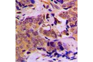 Immunohistochemical analysis of DOK1 staining in human breast cancer formalin fixed paraffin embedded tissue section.