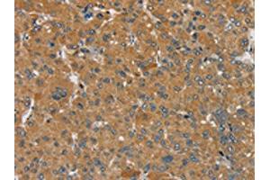 The image on the left is immunohistochemistry of paraffin-embedded Human liver cancer tissue using ABIN7192302(SEMA6D Antibody) at dilution 1/25, on the right is treated with synthetic peptide. (SEMA6D Antikörper)