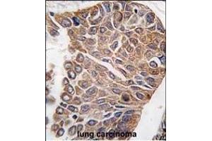 Formalin-fixed and paraffin-embedded human lung carcinoma tissue reacted with AKT2 antibody (C-term), which was peroxidase-conjugated to the secondary antibody, followed by DAB staining. (AKT2 Antikörper  (C-Term))