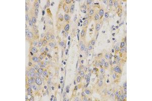 Immunohistochemistry of paraffin-embedded human stomach cancer using MAP2K6 antibody at dilution of 1:200 (x400 lens) (MAP2K6 Antikörper  (AA 1-334))