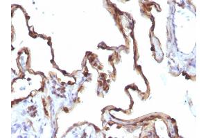 Formalin-fixed, paraffin-embedded human Lung Carcinoma stained with Cytokeratin 7 Mouse Monoclonal Antibody (KRT7/1198). (Cytokeratin 7 Antikörper)