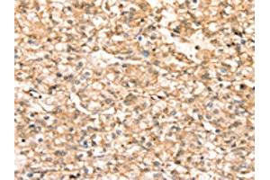 The image on the left is immunohistochemistry of paraffin-embedded Human prostate cancer tissue using ABIN7192443(SLC25A38 Antibody) at dilution 1/20, on the right is treated with synthetic peptide. (SLC25A38 Antikörper)