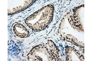 Immunohistochemical staining of paraffin-embedded Adenocarcinoma of ovary tissue N93ing anti-CYP1A2 mouse monoclonal antibody. (CYP1A2 Antikörper)