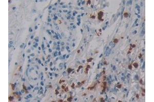 Detection of DEFa4 in Human Skin cancer Tissue using Polyclonal Antibody to Defensin Alpha 4, Corticostatin (DEFa4) (DEFA4 Antikörper  (AA 23-97))