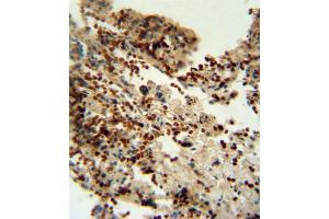 INDO antibody (Center) (ABIN650713 and ABIN2839358) immunohistochemistry analysis in formalin fixed and paraffin embedded human lung carcinoma followed by peroxidase conjugation of the secondary antibody and DAB staining. (IDO1 Antikörper  (AA 79-105))