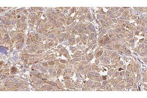 ABIN6276505 at 1/100 staining Human Melanoma tissue by IHC-P.