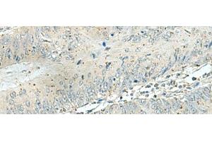 Immunohistochemistry of paraffin-embedded Human colorectal cancer tissue using DENND6A Polyclonal Antibody at dilution of 1:120(x200) (FAM116A Antikörper)