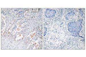 Immunohistochemistry analysis of paraffin-embedded human lung carcinoma tissue using GNB5 antibody. (GNB5 Antikörper  (Internal Region))