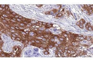 ABIN6277405 at 1/100 staining Human Head and neck cancer tissue by IHC-P. (ABCC5 Antikörper  (N-Term))