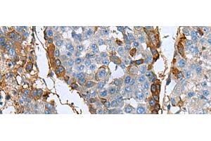 Immunohistochemistry of paraffin-embedded Human liver cancer tissue using TGFBI Polyclonal Antibody at dilution of 1:60(x200) (TGFBI Antikörper)