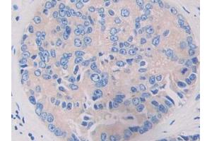 DAB staining on IHC-P; Samples: Human Prostate cancer Tissue (LRRFIP1 Antikörper  (AA 615-735))