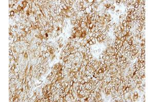 IHC-P Image Immunohistochemical analysis of paraffin-embedded DLD1 xenograft, using GMDS, antibody at 1:500 dilution. (GMDS Antikörper)