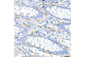 Immunohistochemistry of paraffin-embedded human liver cancer using LPP Rabbit mAb (ABIN7268284) at dilution of 1:100 (40x lens). (LPP Antikörper)