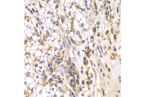 Immunohistochemistry of paraffin-embedded human kidney cancer using SRPK1 antibody (ABIN5973465) at dilution of 1/200 (40x lens). (SRPK1 Antikörper)