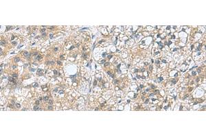 Immunohistochemistry of paraffin-embedded Human liver cancer tissue using RAB39A Polyclonal Antibody at dilution of 1:70(x200) (RAB39A Antikörper)