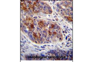 HAX1 Antibody (C-term) (ABIN656245 and ABIN2845562) immunohistochemistry analysis in formalin fixed and paraffin embedded human esophageal carcinoma followed by peroxidase conjugation of the secondary antibody and DAB staining. (HAX1 Antikörper  (C-Term))
